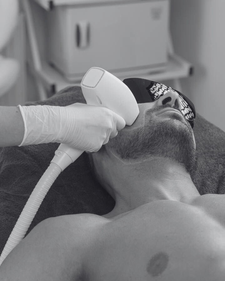 Depilación Láser Hombre